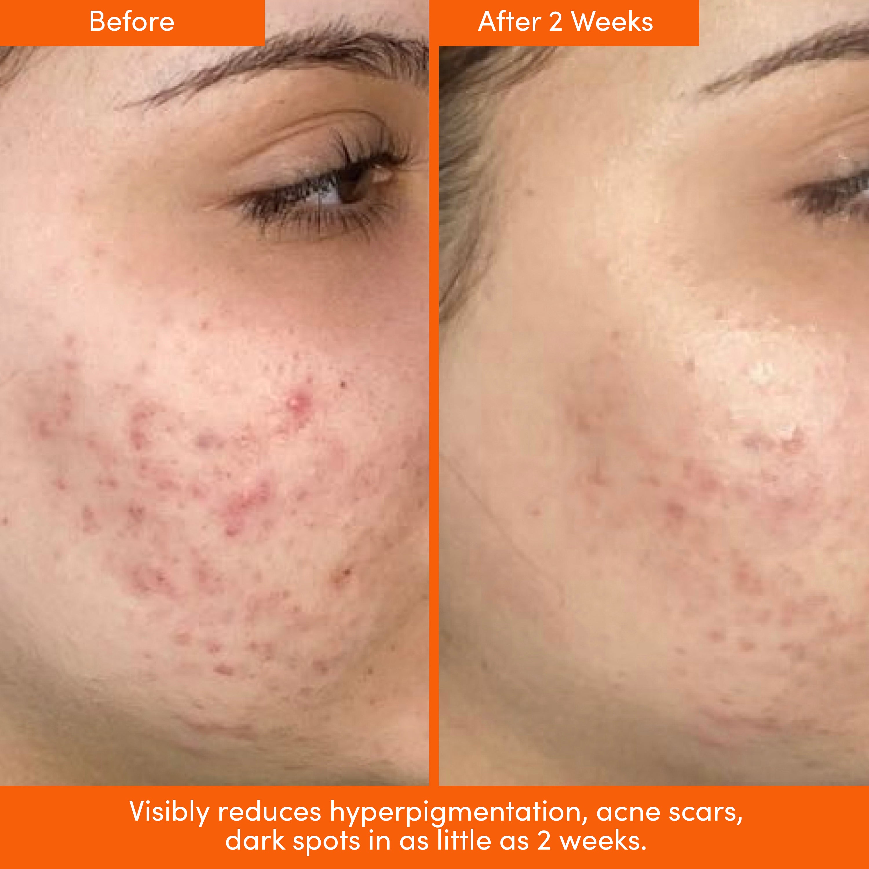 *WELCOME BUNDLE* AHA Serum, Peptide Cream & Tote + FREE SPF ($39)!