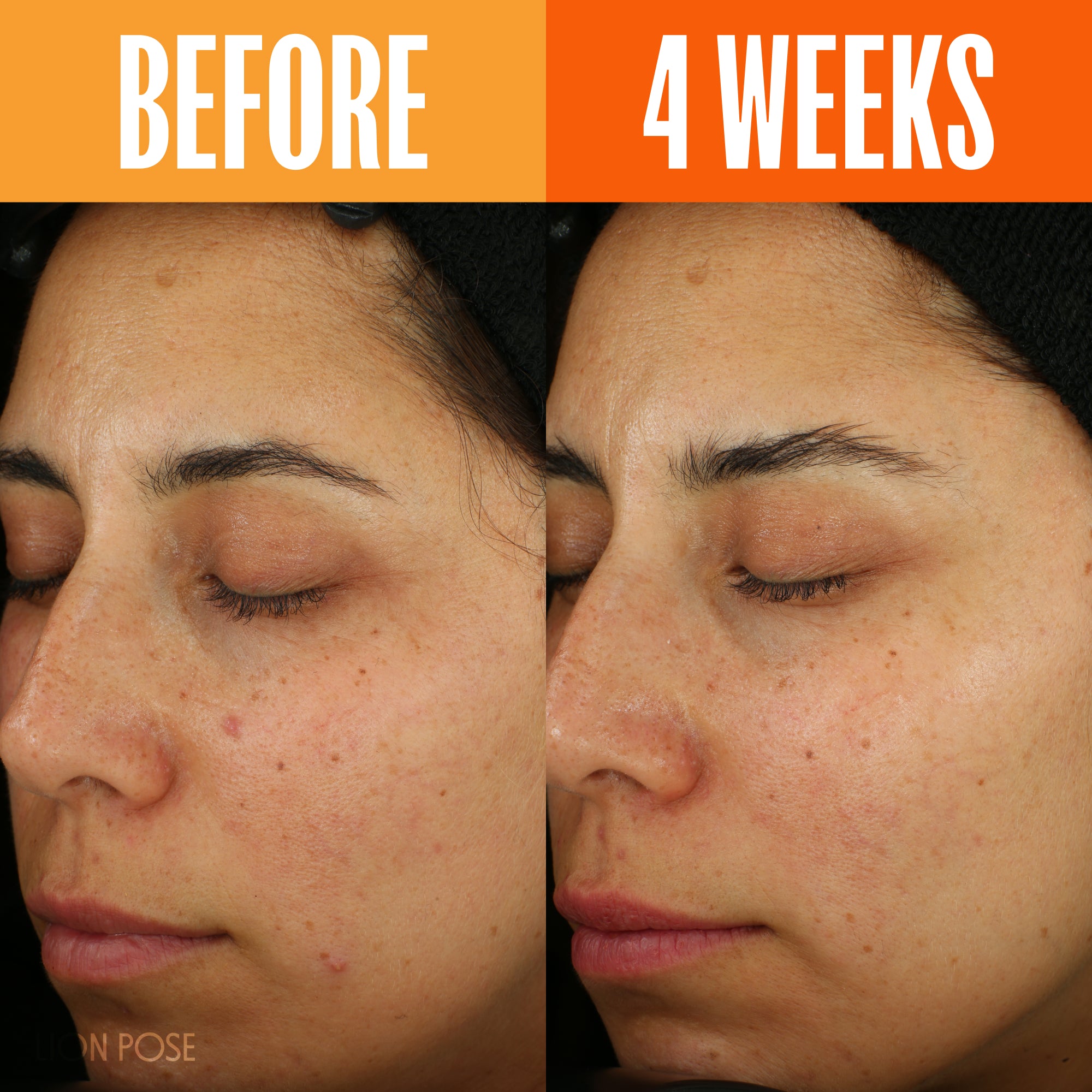 UNSPOTTED 4X® Dark Spot Correcting Serum for Hyperpigmentation