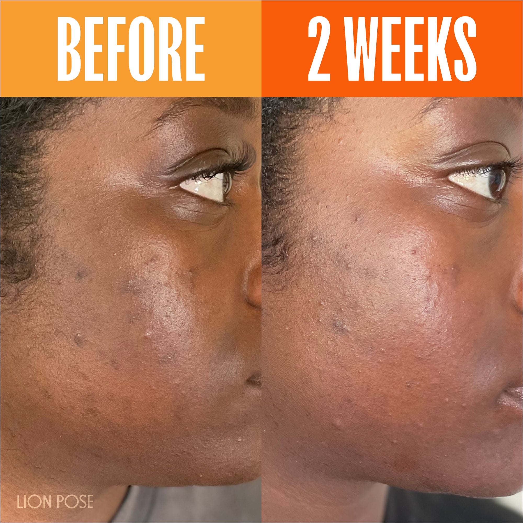 UNSPOTTED 4X® Dark Spot Correcting Serum for Hyperpigmentation