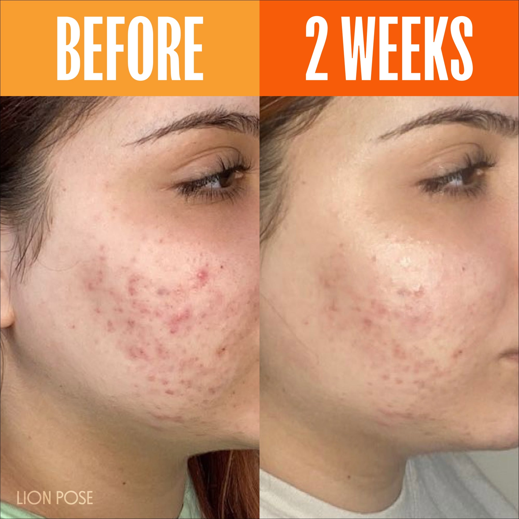 UNSPOTTED 4X® Dark Spot Correcting Serum for Hyperpigmentation