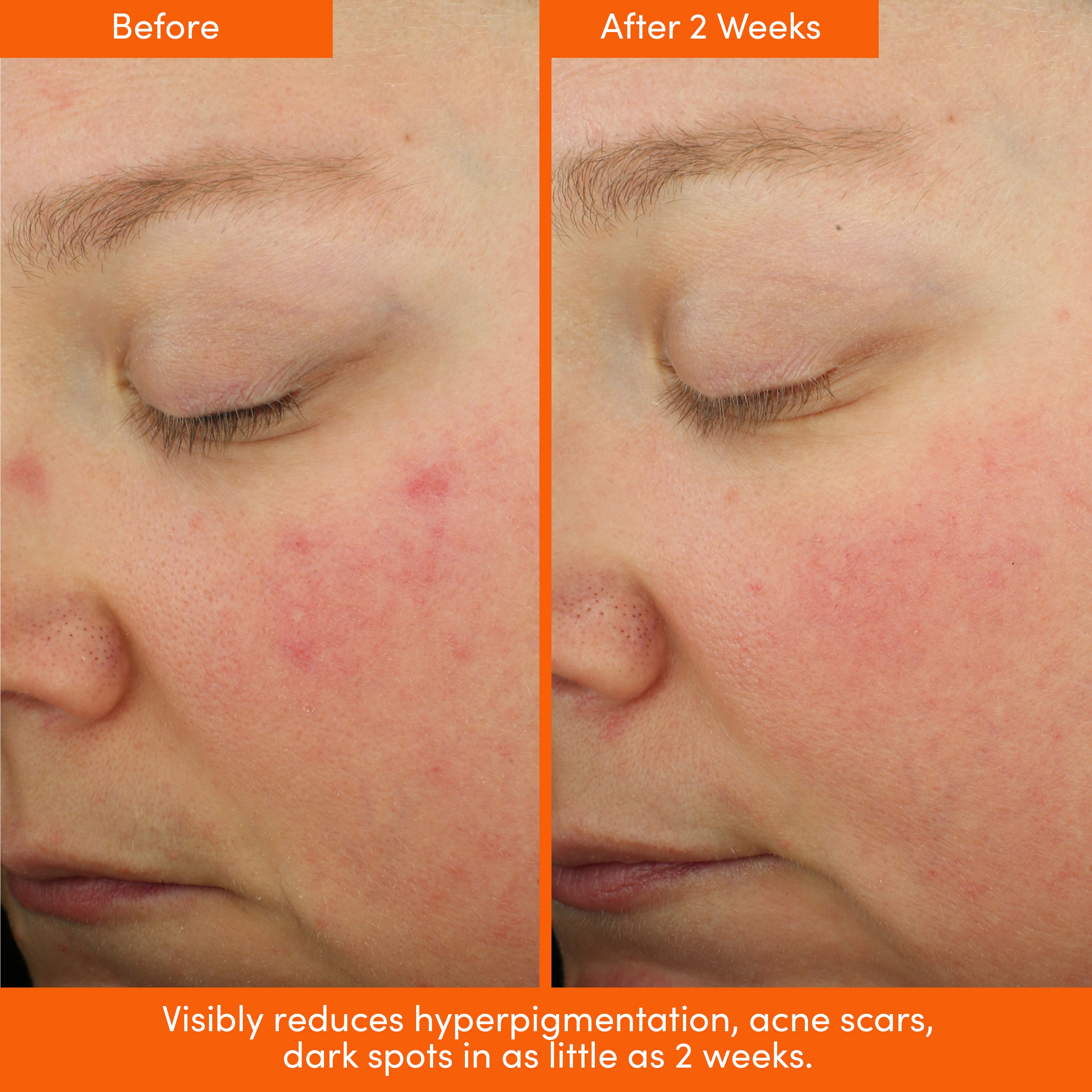 *WELCOME BUNDLE* AHA Serum, Peptide Cream & Tote + FREE SPF ($39)!