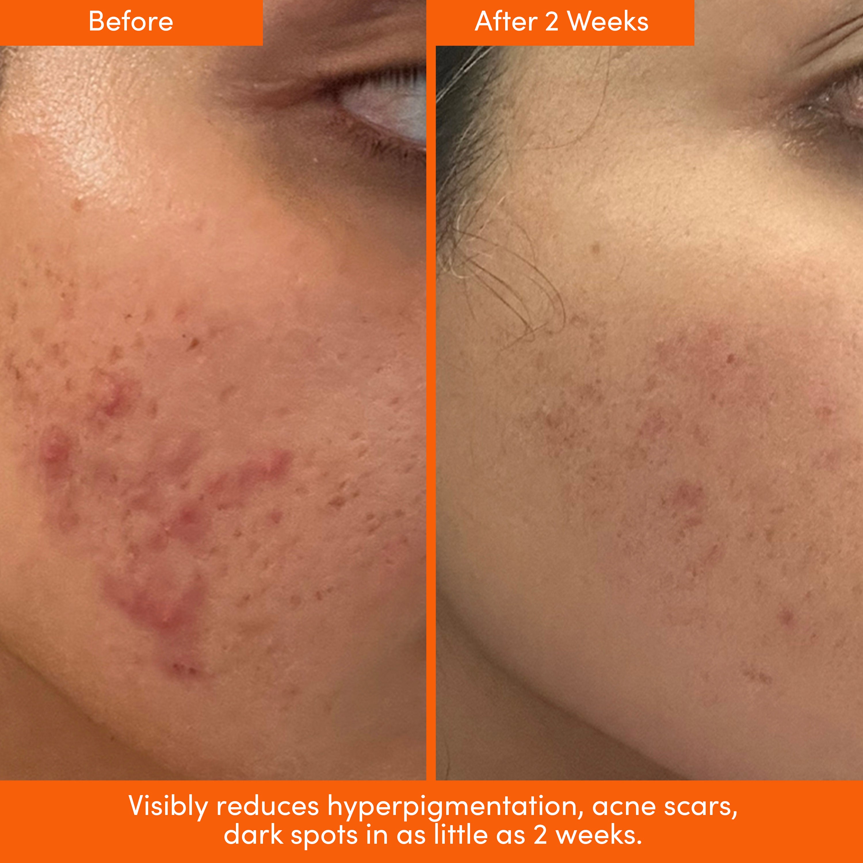 THE PLACENTA FACIAL Dark Spot Serum + Barrier Repair Bundle