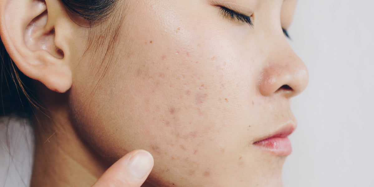 How to Treat Hyperpigmentation, Dark Spots, and Melasma on Skin of Color
