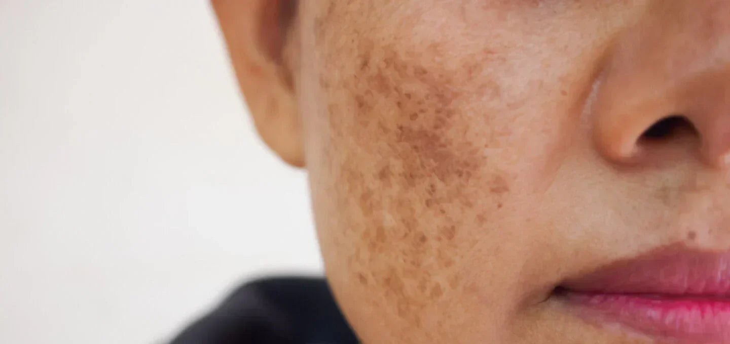 What Causes Melasma? The Best Treatments for Skin Discoloration